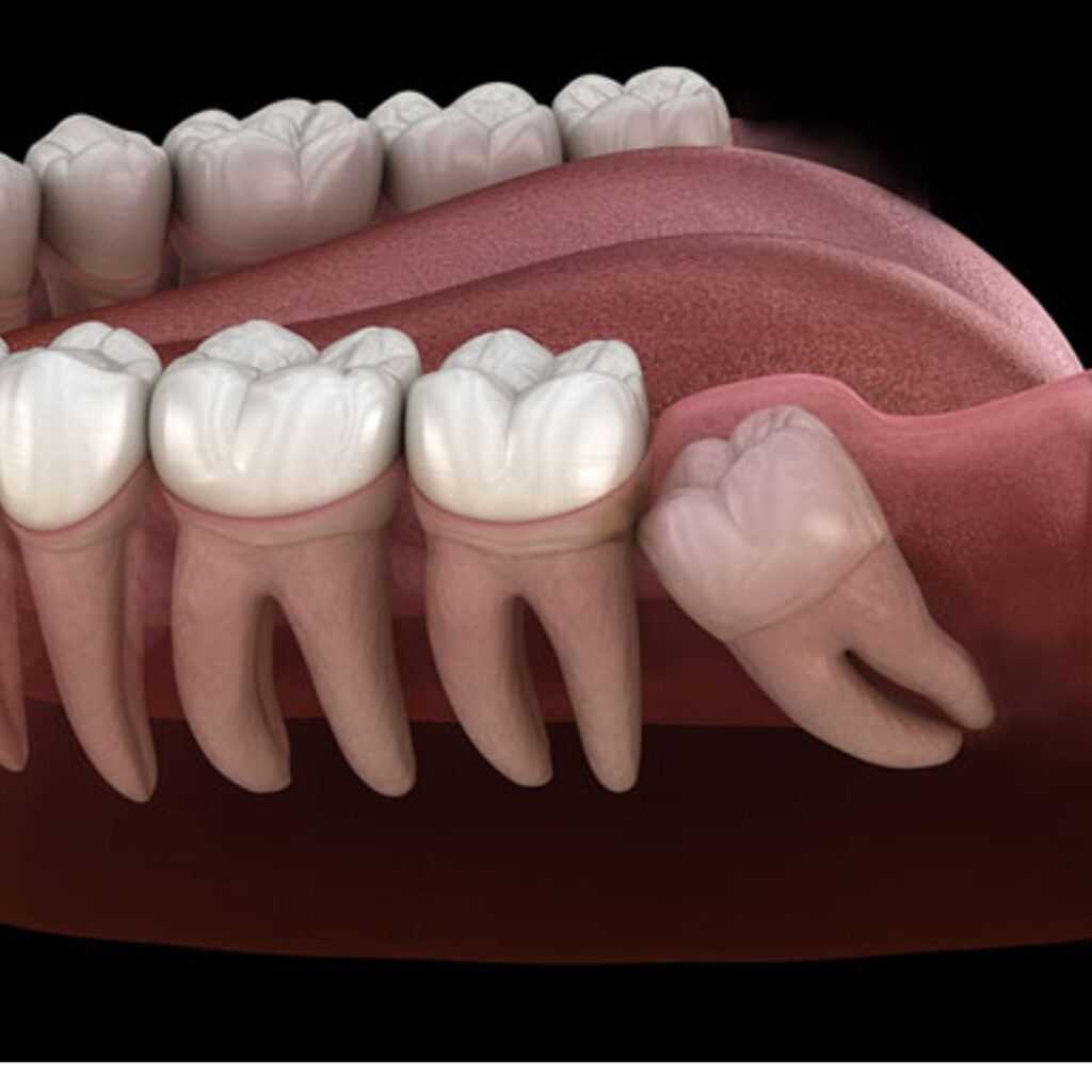 Impaction treatment Images