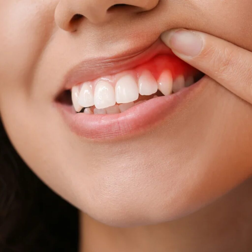 Gum Treatments Image