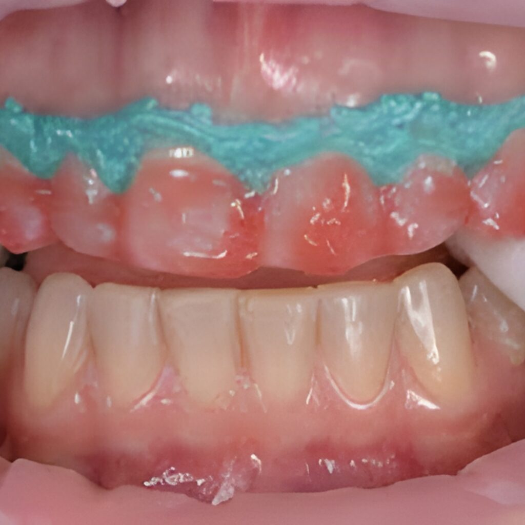 Teeth Bleaching Image