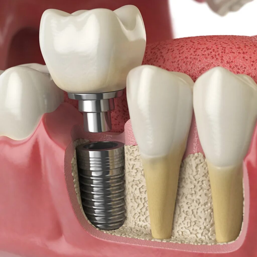 Dental Implants Image