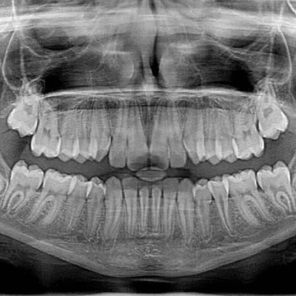 Intra oral imaging (X-rays) Image