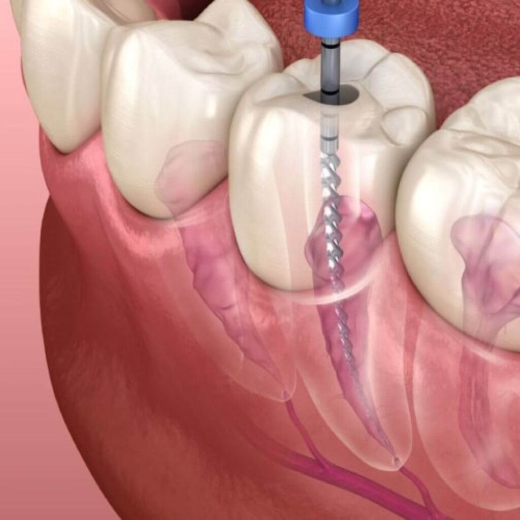 Root canal treatment (specialized) Image