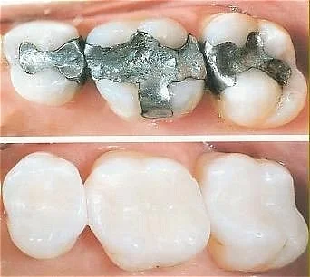 Tooth-Colored Fillings Image